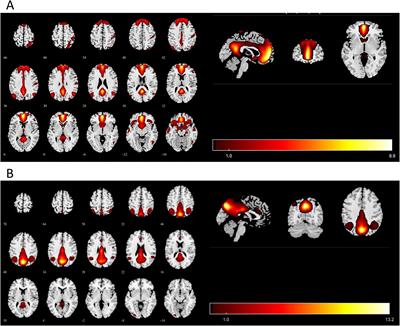 Exploring the neural link between childhood maltreatment and depression: a default mode network rs-fMRI study